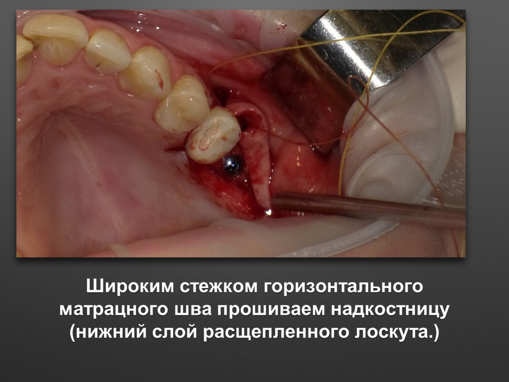 Биоимплант ГАП. Имплантация в дистальном отделе