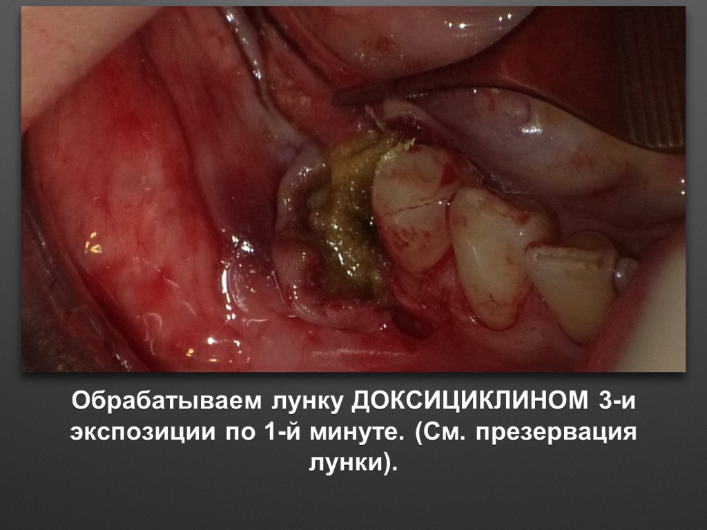 Горизонтальное увеличение альвеолярного отростка