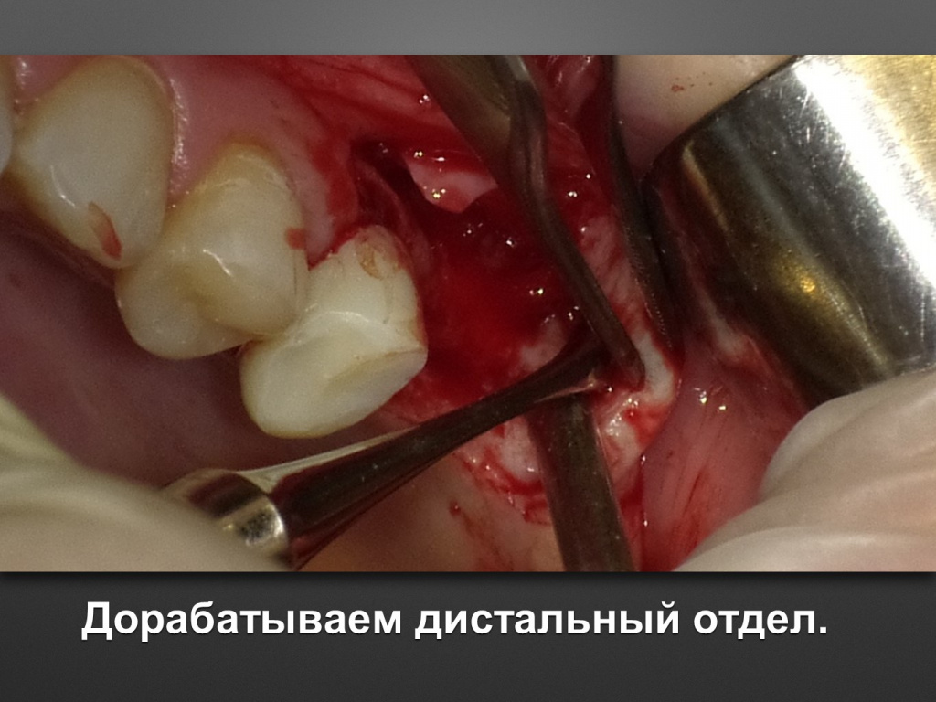 Биоимплант ГАП. Имплантация в дистальном отделе