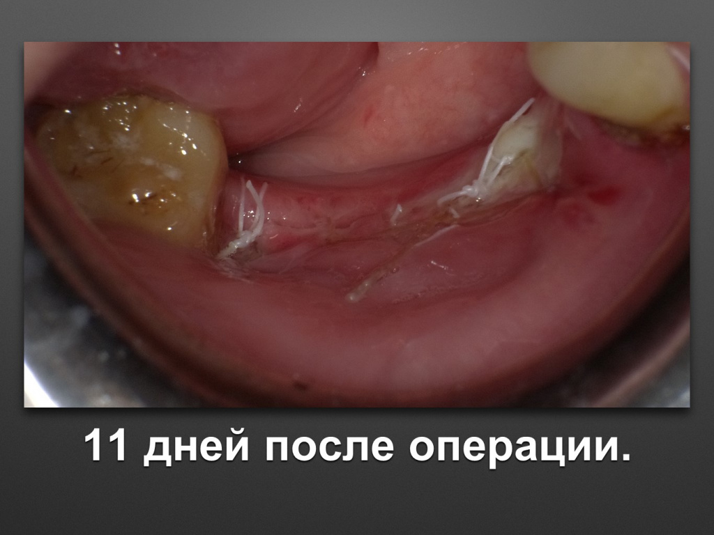 Горизонтальное увеличение альвеолярного отростка