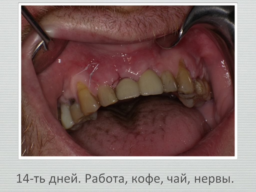 Ранозаживление