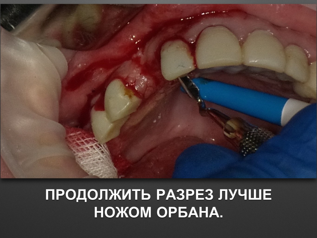 БАЛДЕЙ НОГА