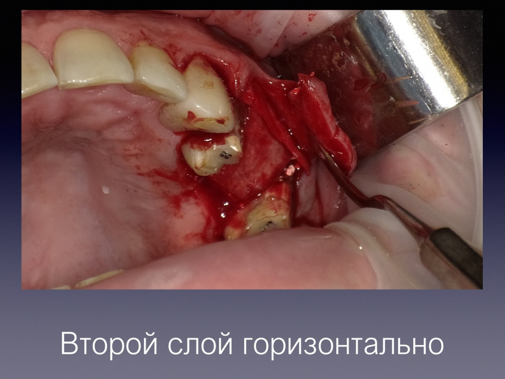 Постановка импланта