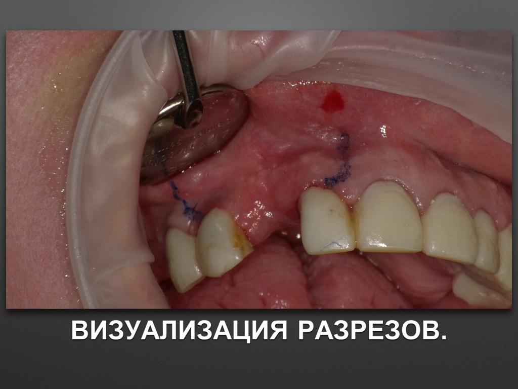 БАЛДЕЙ НОГА