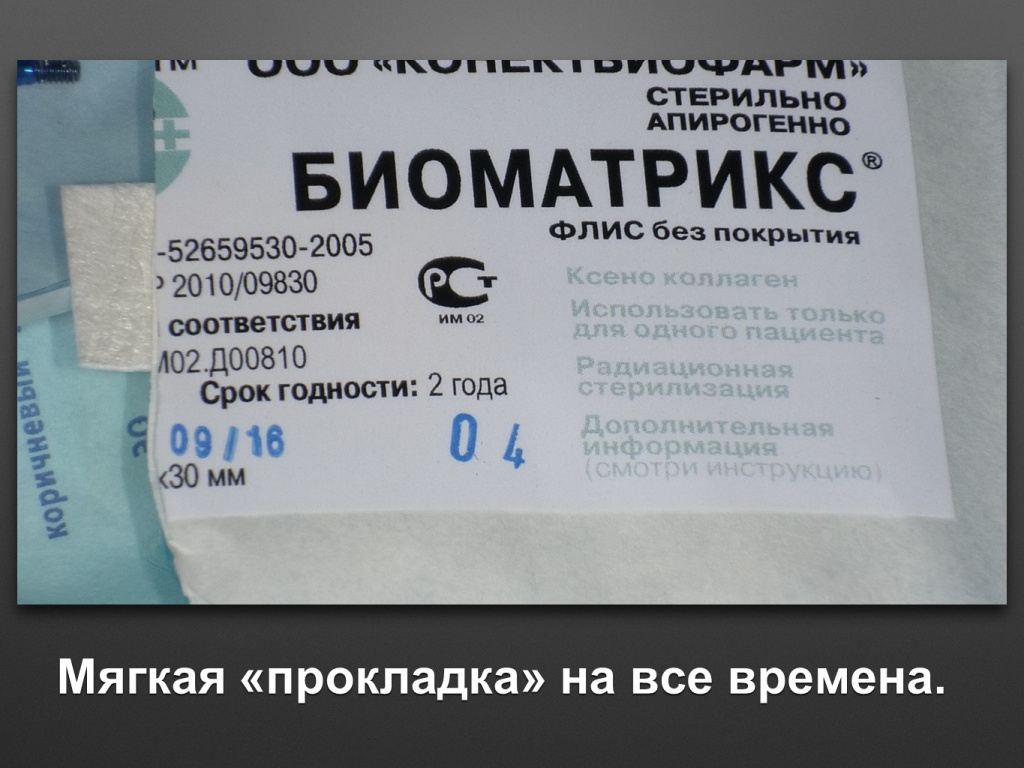 Биоимплант ГАП. Имплантация в дистальном отделе