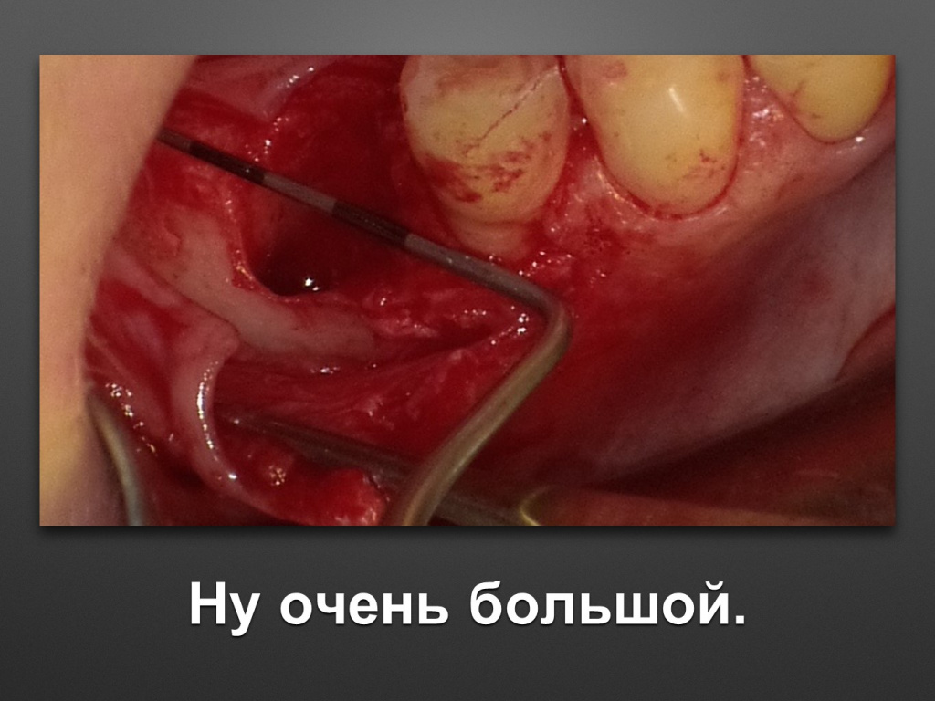 Горизонтальное увеличение альвеолярного отростка