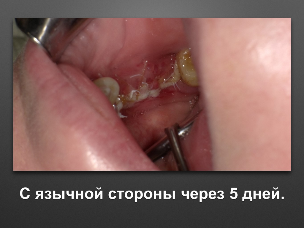 Горизонтальное увеличение альвеолярного отростка
