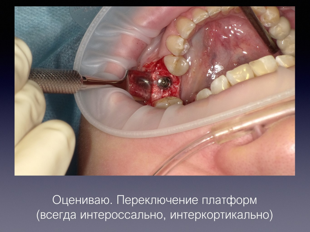 Постановка имплантата после презервации