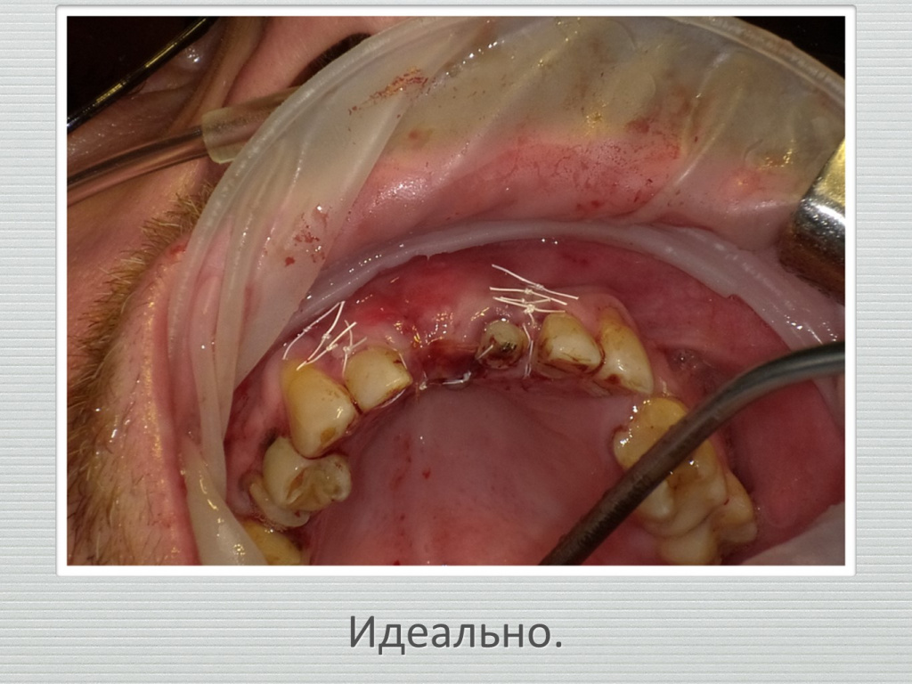 Ранозаживление
