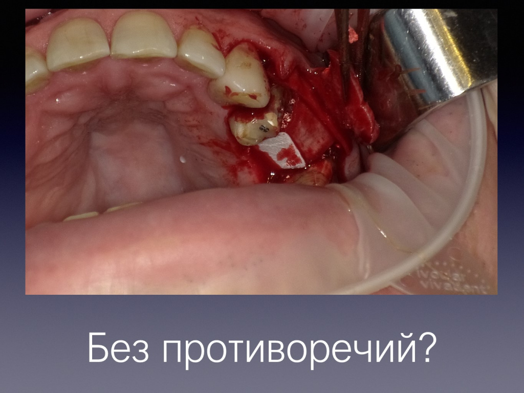 Постановка импланта