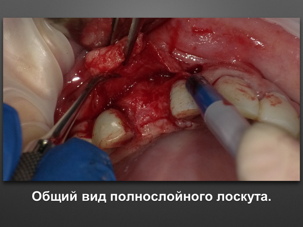 БАЛДЕЙ НОГА