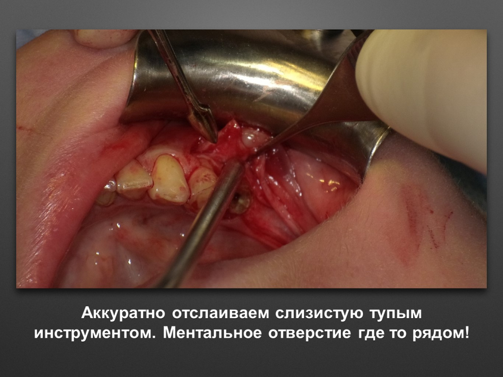 Горизонтальное увеличение альвеолярного отростка