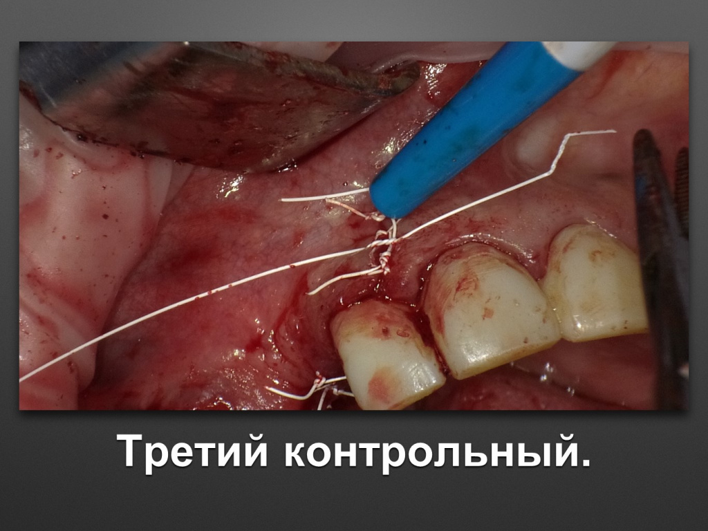 БАЛДЕЙ НОГА