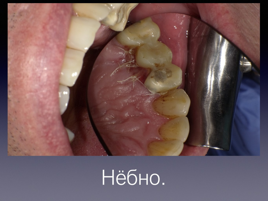 Постановка импланта