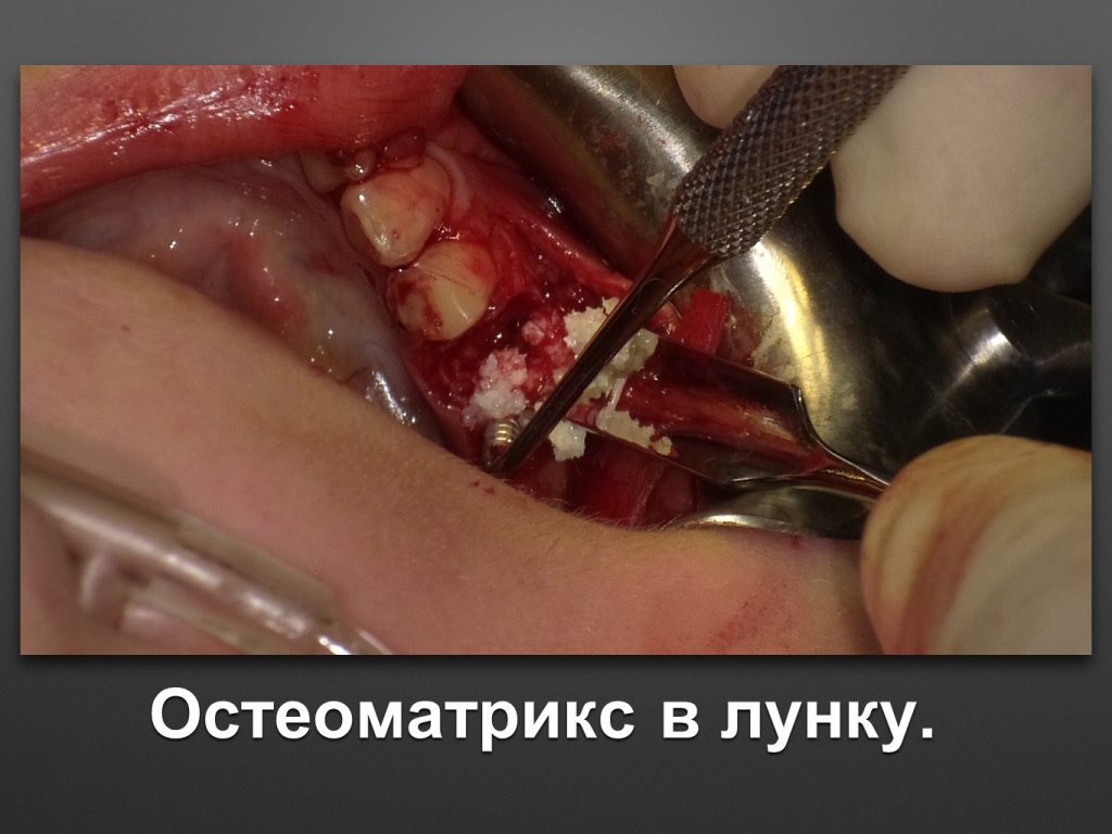 Горизонтальное увеличение альвеолярного отростка
