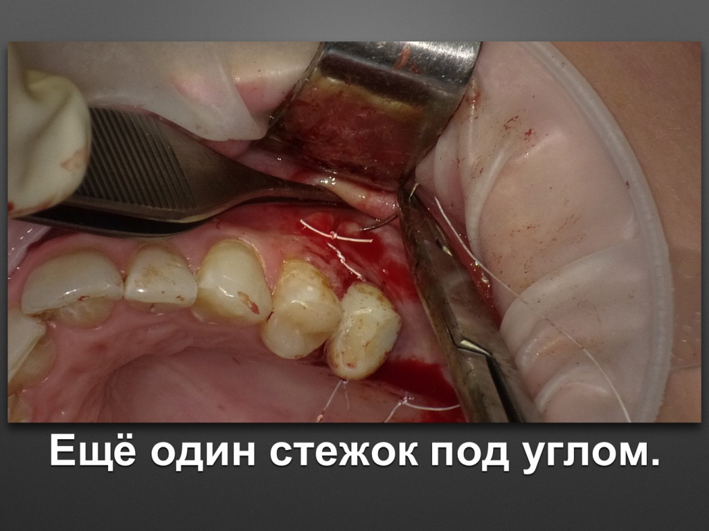 Биоимплант ГАП. Имплантация в дистальном отделе