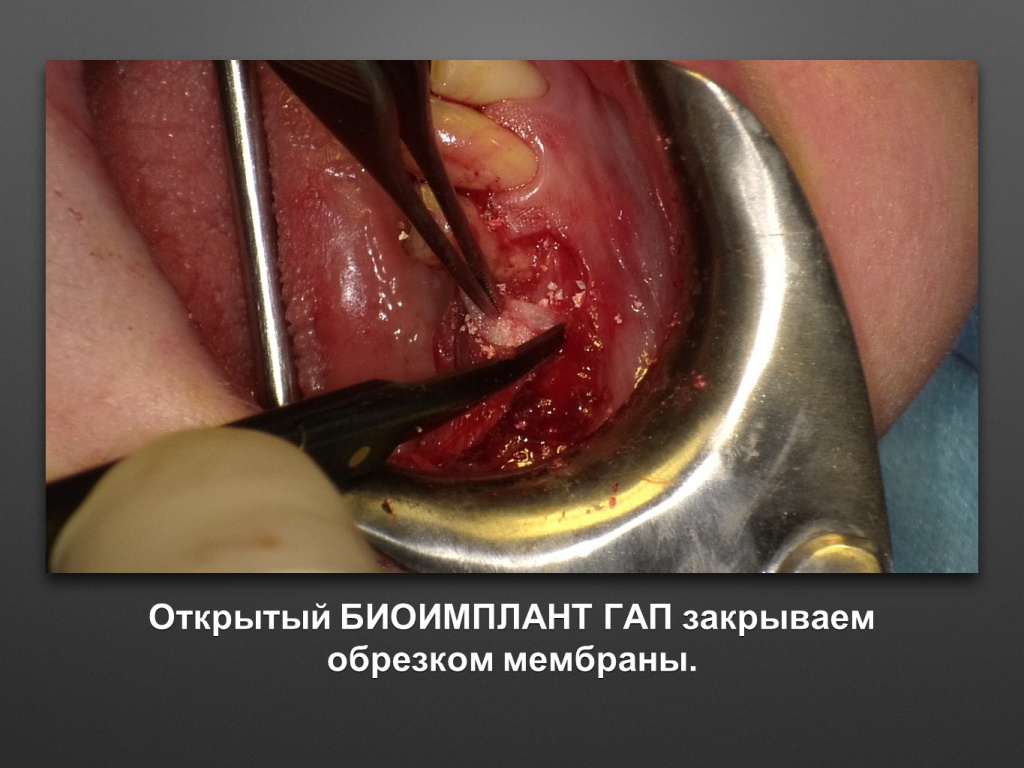 Горизонтальное увеличение альвеолярного отростка