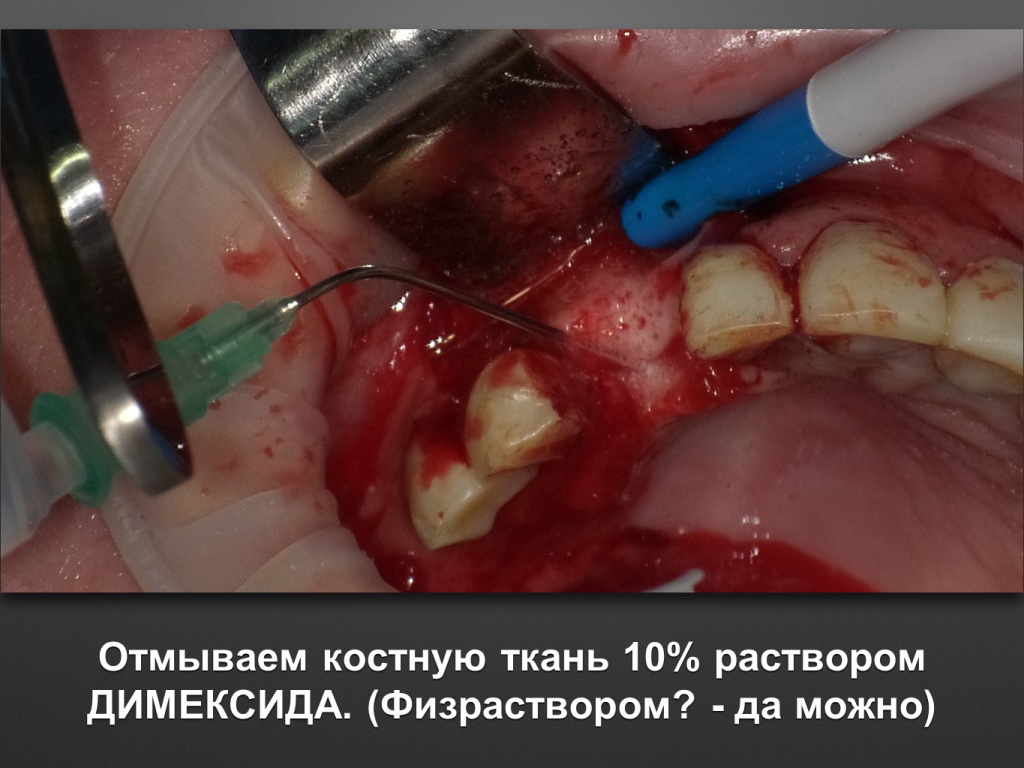 БАЛДЕЙ НОГА