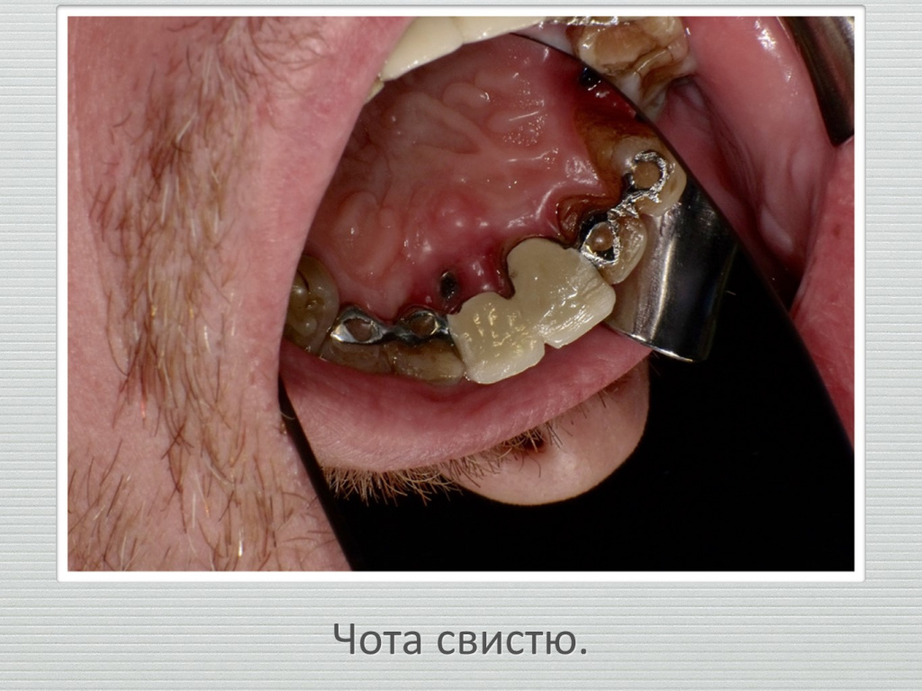 Ранозаживление