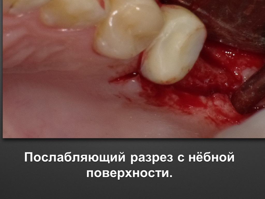 Биоимплант ГАП. Имплантация в дистальном отделе