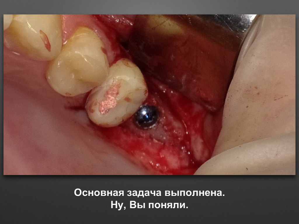 Биоимплант ГАП. Имплантация в дистальном отделе