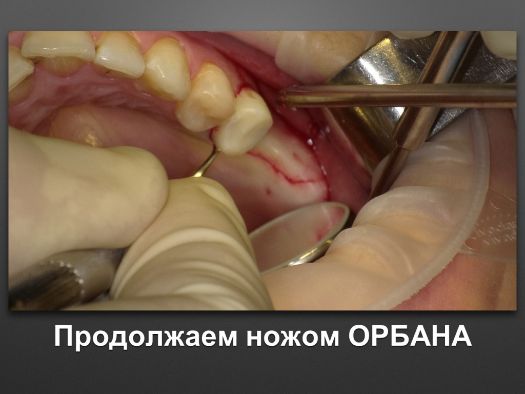 Биоимплант ГАП. Имплантация в дистальном отделе