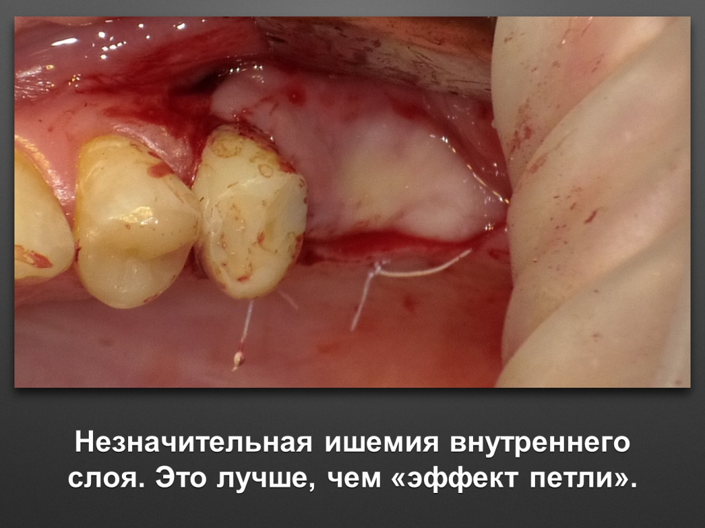 Биоимплант ГАП. Имплантация в дистальном отделе