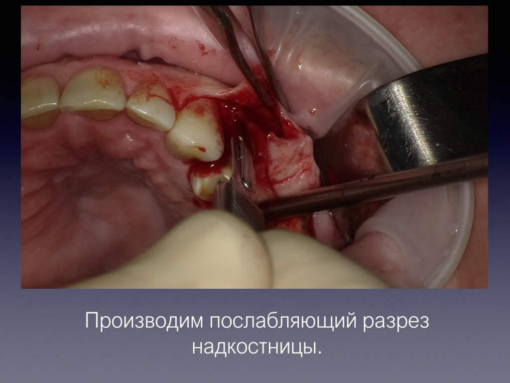 Постановка импланта