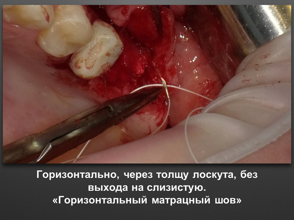 Биоимплант ГАП. Имплантация в дистальном отделе