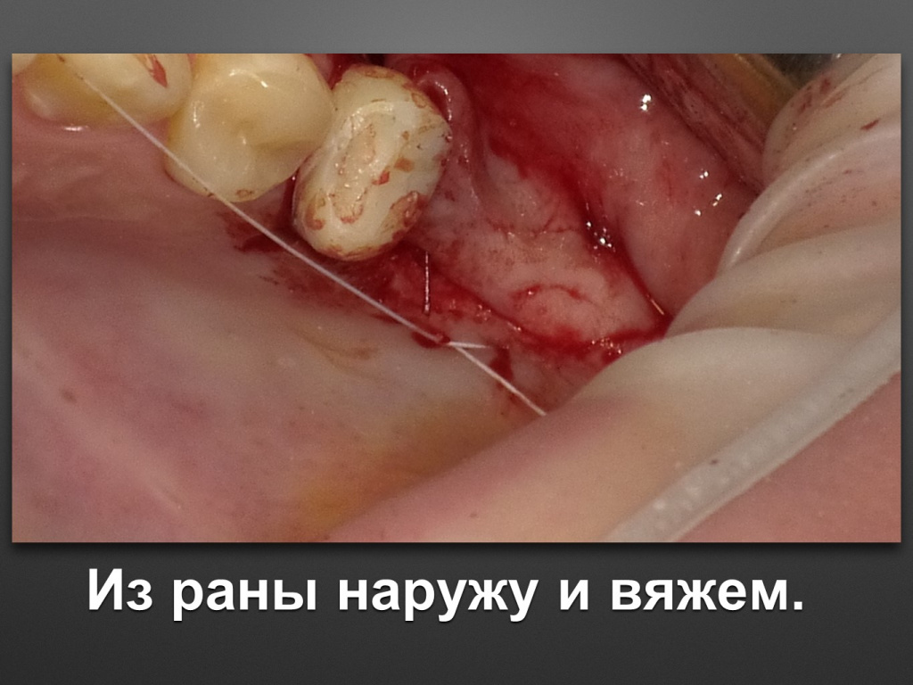 Биоимплант ГАП. Имплантация в дистальном отделе