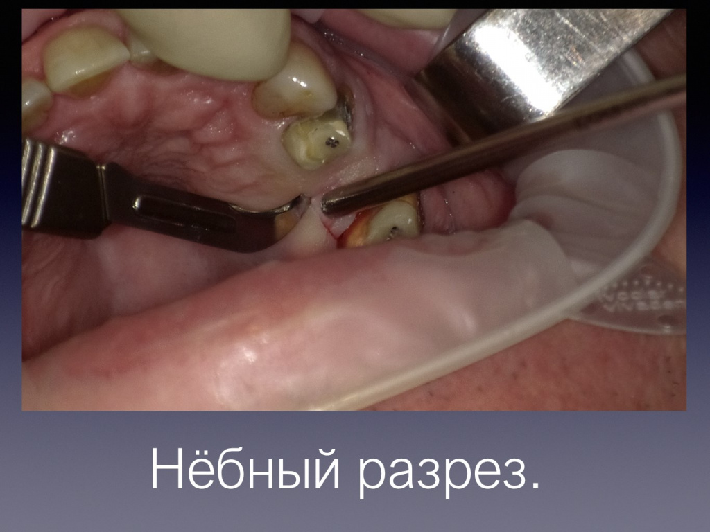 Постановка импланта