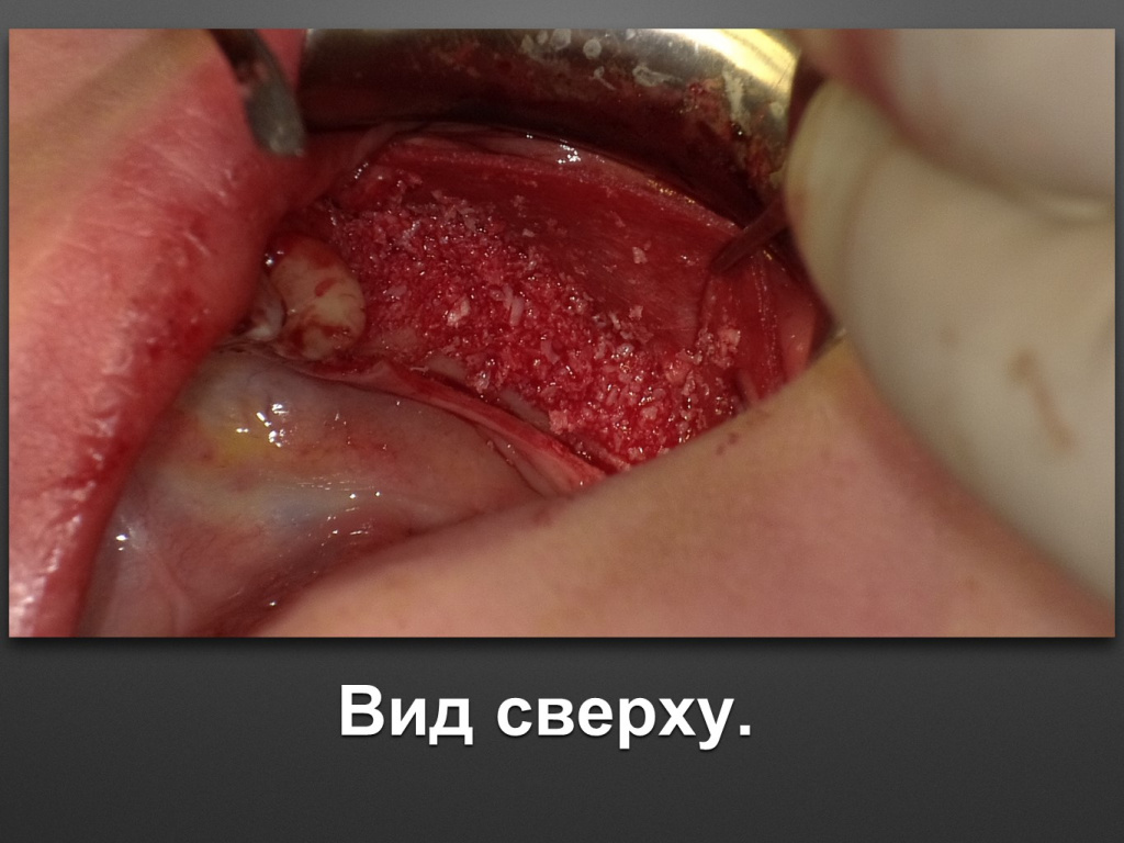 Горизонтальное увеличение альвеолярного отростка