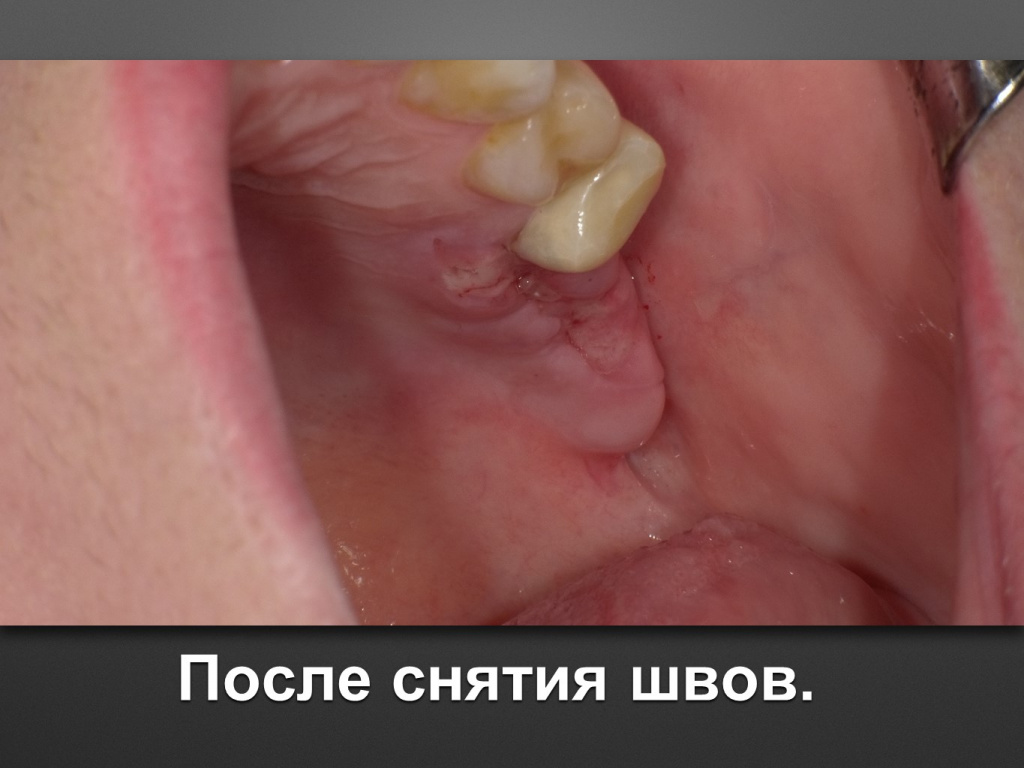 Биоимплант ГАП. Имплантация в дистальном отделе