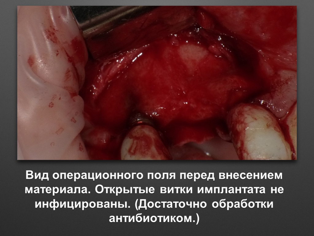 БАЛДЕЙ НОГА