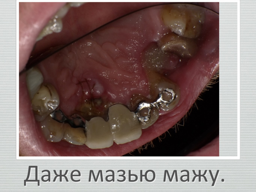 Ранозаживление