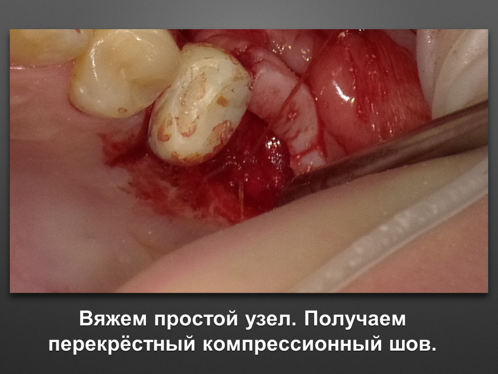 Биоимплант ГАП. Имплантация в дистальном отделе