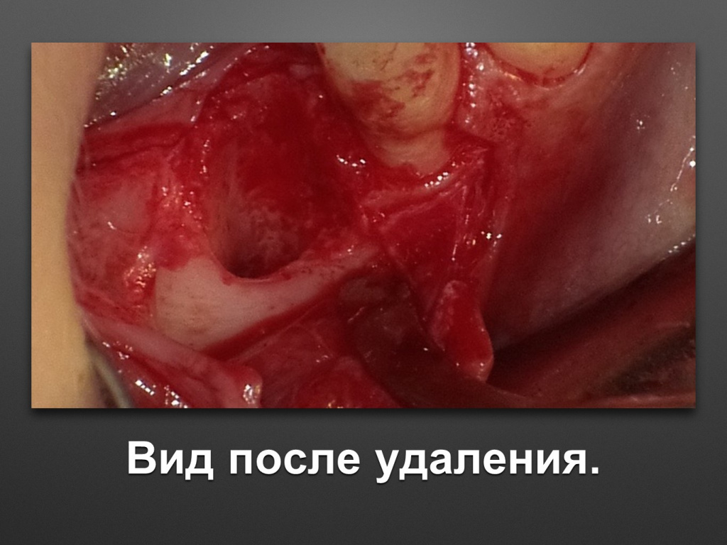 Горизонтальное увеличение альвеолярного отростка