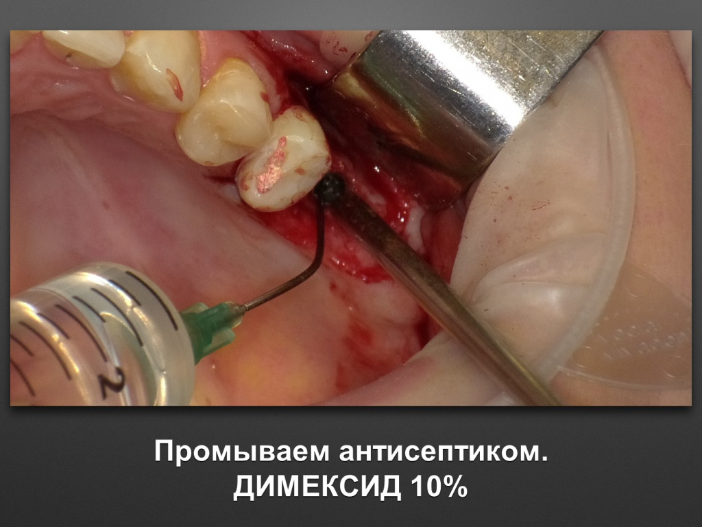Биоимплант ГАП. Имплантация в дистальном отделе