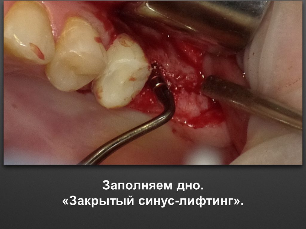 Биоимплант ГАП. Имплантация в дистальном отделе