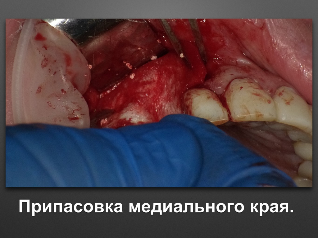 БАЛДЕЙ НОГА