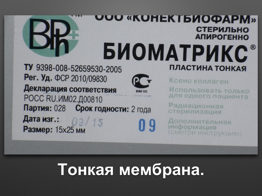 Биоимплант ГАП. Имплантация в дистальном отделе