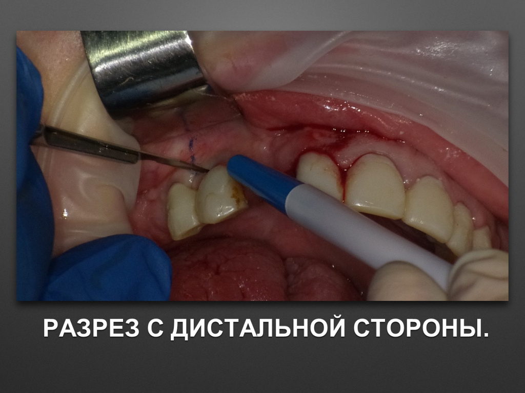 БАЛДЕЙ НОГА