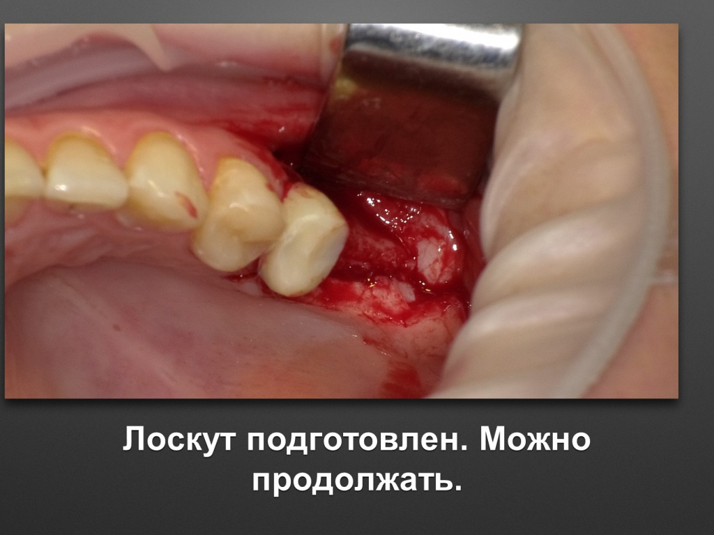 Биоимплант ГАП. Имплантация в дистальном отделе