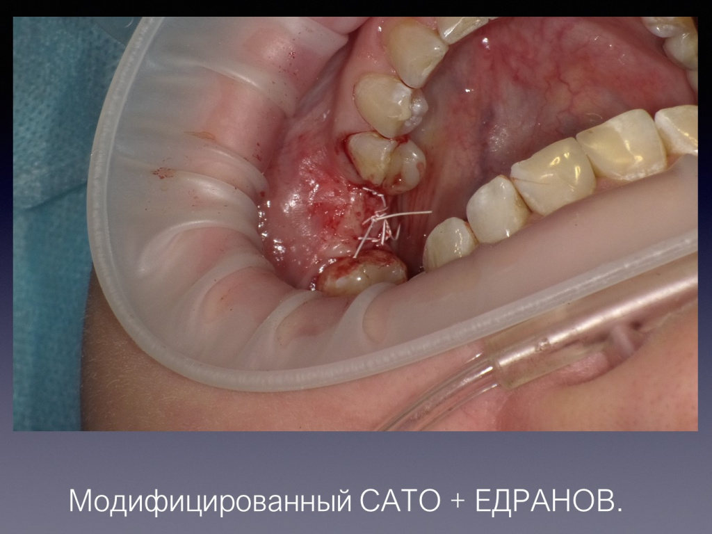 Постановка имплантата после презервации