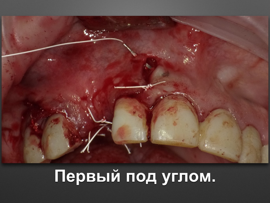 БАЛДЕЙ НОГА