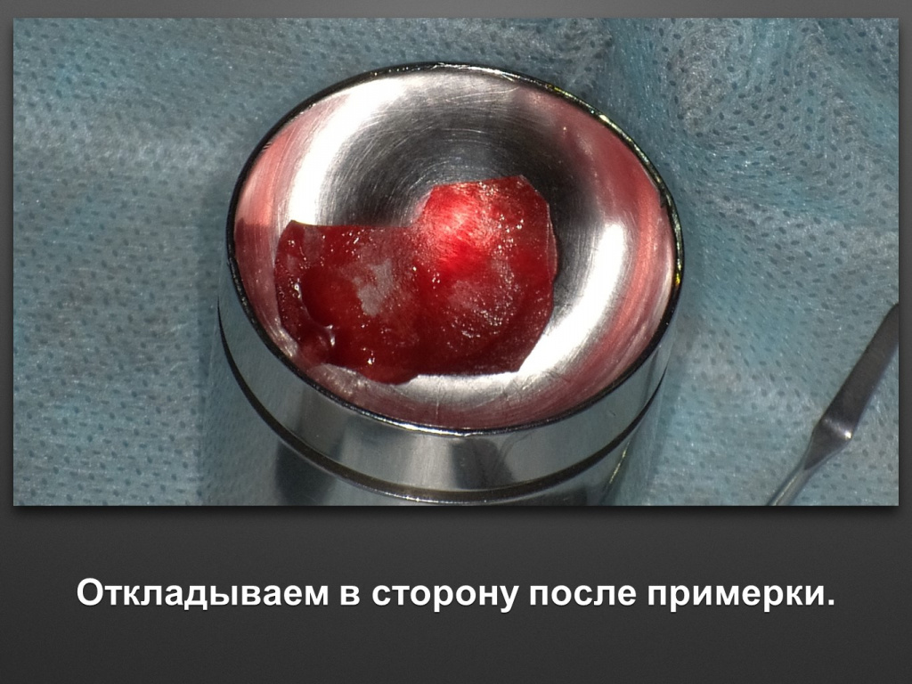 Биоимплант ГАП. Имплантация в дистальном отделе