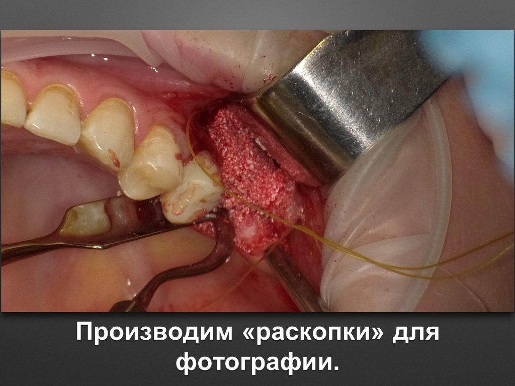 Биоимплант ГАП. Имплантация в дистальном отделе