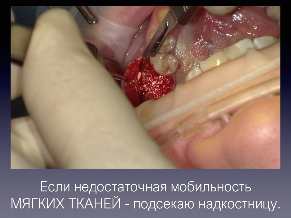 Постановка имплантата после презервации