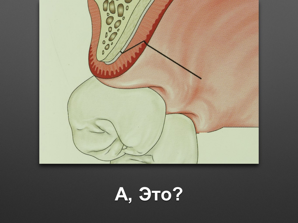 Биоимплант ГАП. Имплантация в дистальном отделе