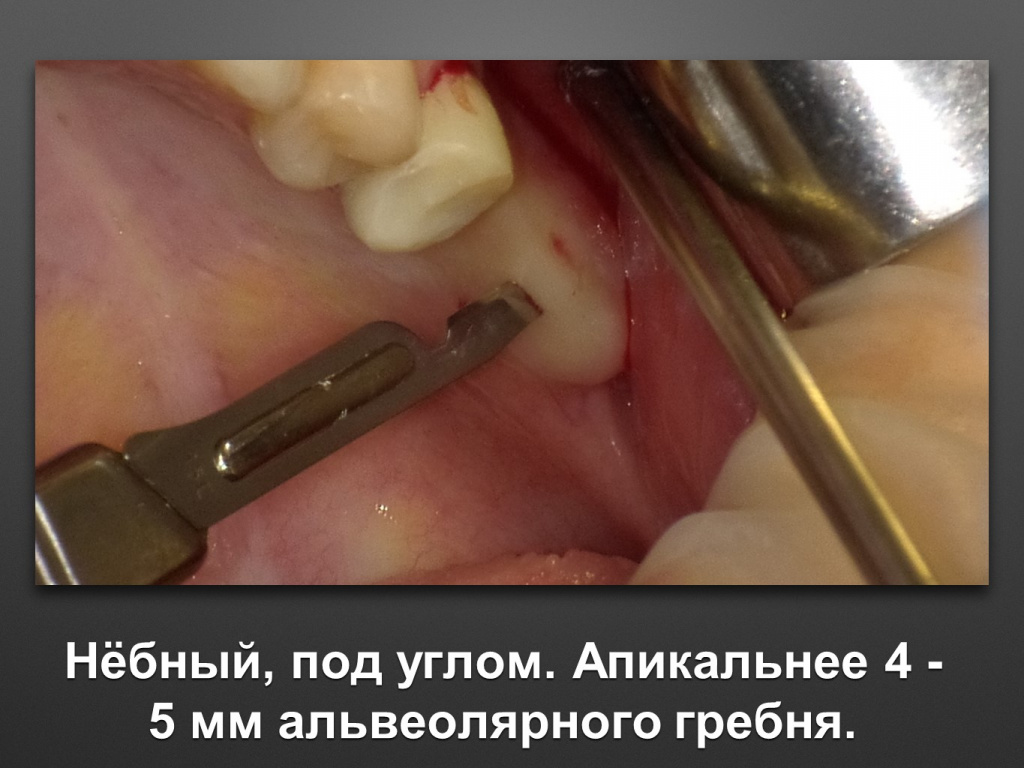 Биоимплант ГАП. Имплантация в дистальном отделе